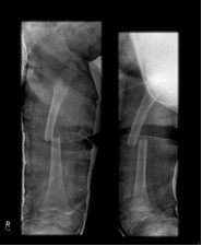 Paediatric Femur Fracture Hip Spica